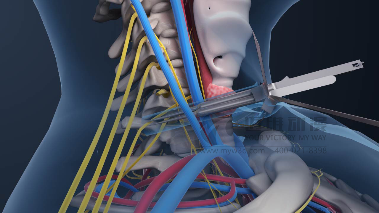 對(duì)于醫(yī)療三維動(dòng)畫你會(huì)怎么做？(圖2)