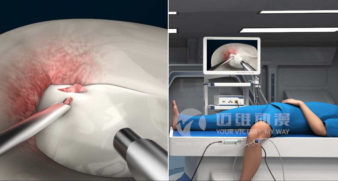 醫(yī)學(xué)醫(yī)療行業(yè)為什么青睞于三維動畫？(圖4)