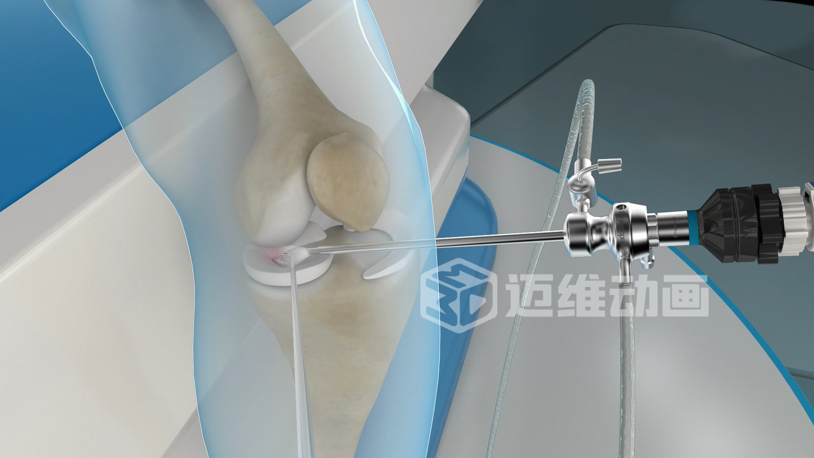 關(guān)節(jié)鏡手術(shù)三維動(dòng)畫(huà)